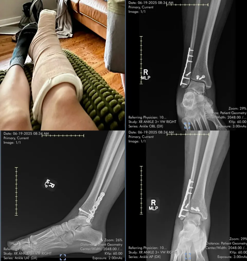 Photo of a leg in a cast beside X-ray images of a repaired ankle